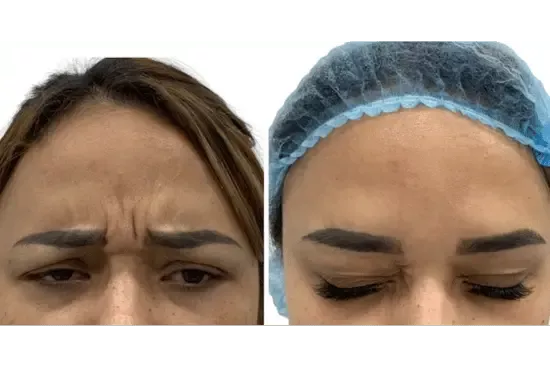 a comparison of women's foreheads