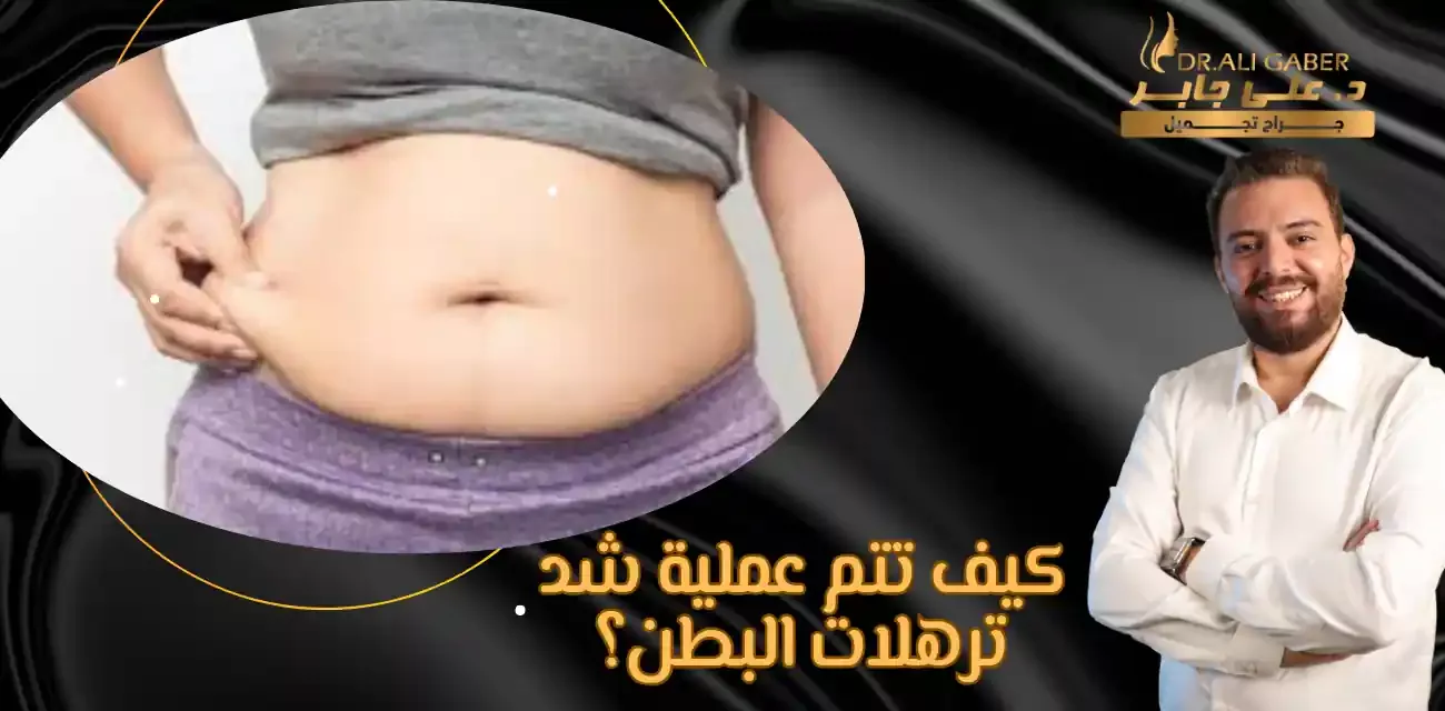 شد ترهلات البطن السفلية