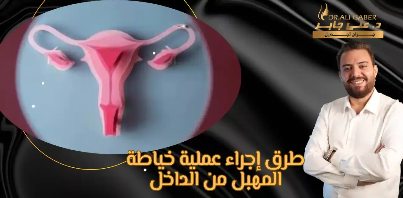 خياطة المهبل من الداخل