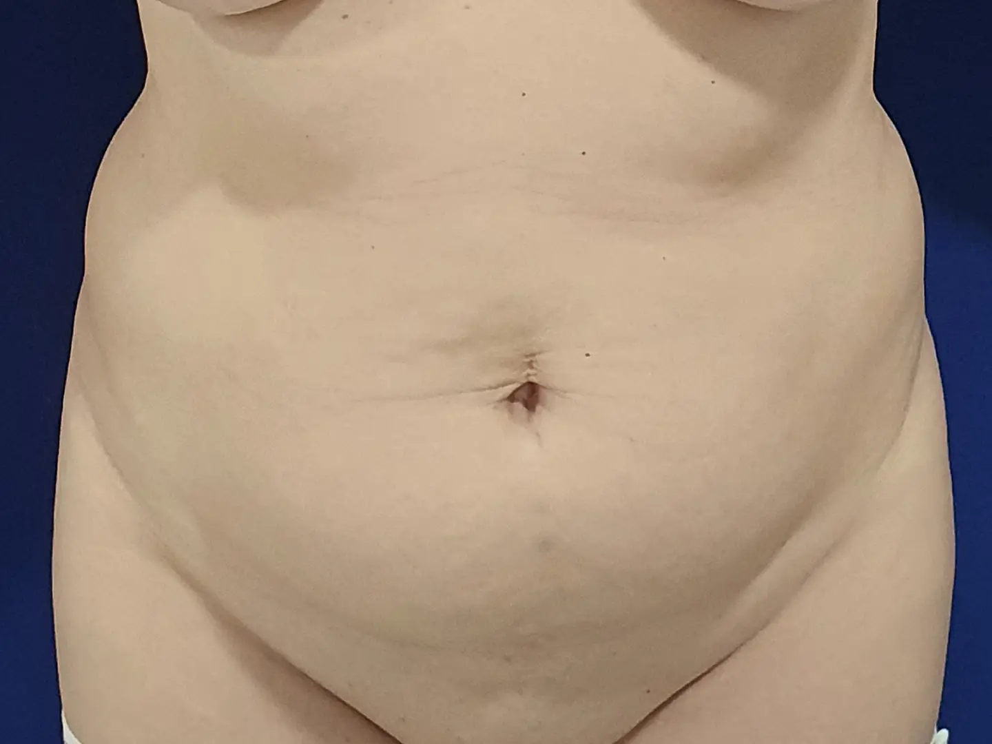 Vaginoplastie