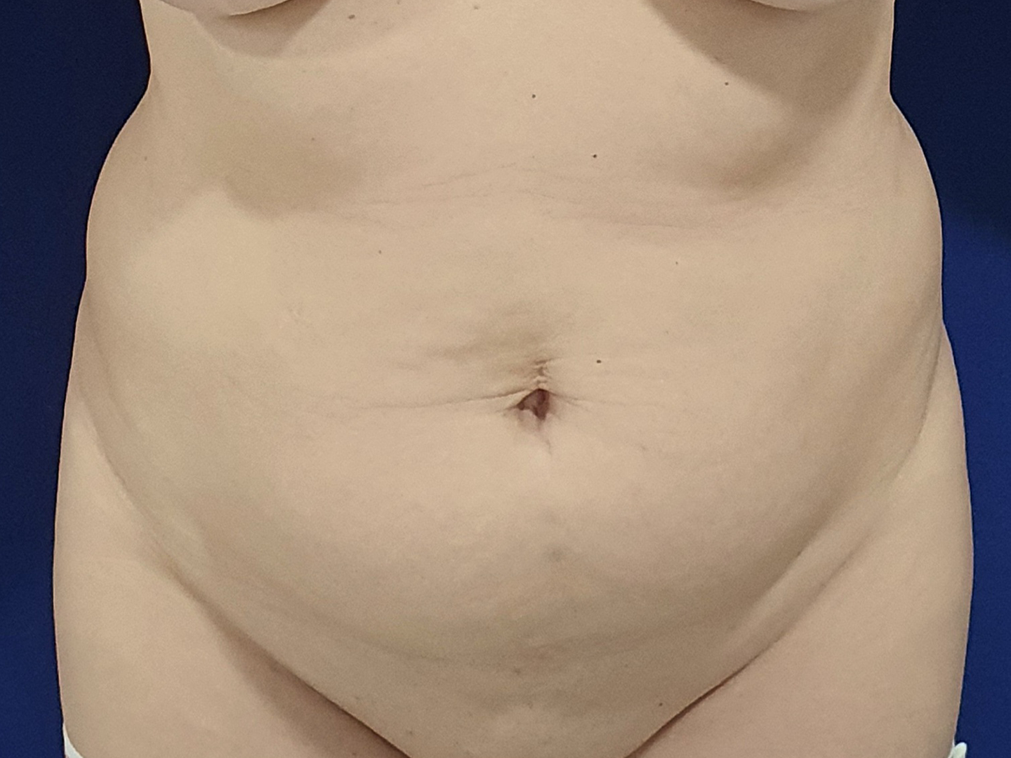 Vaginoplastie