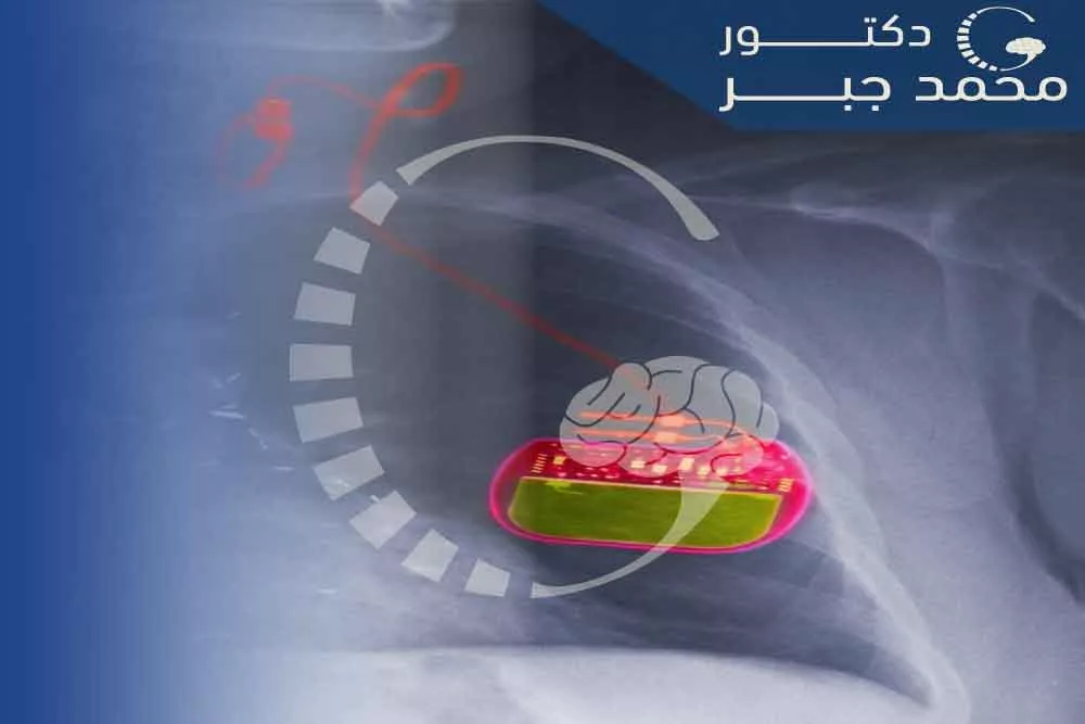 ุชุญููุฒ ุงูุนุตุจ ุงูู
ุจูู
(Vagus nerve stimulation):