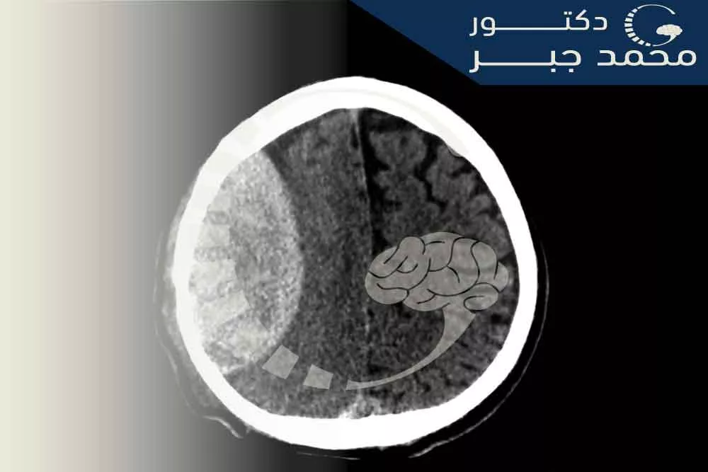 ุชุดุฎูุต ูุฒูู ุชุญุช ุงูุฃู
ุงูุฌุงููุฉ.