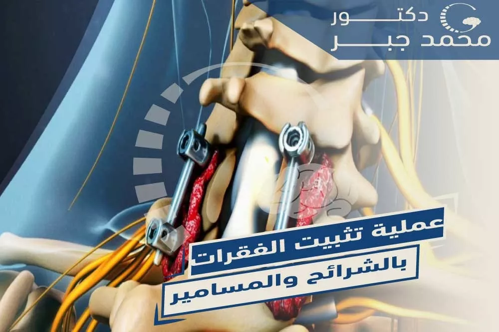 ุนู
ููุฉ ุชุซุจูุช ุงูููุฑุงุช ุจุงูุดุฑุงุฆุญ ูุงูู
ุณุงู
ูุฑ