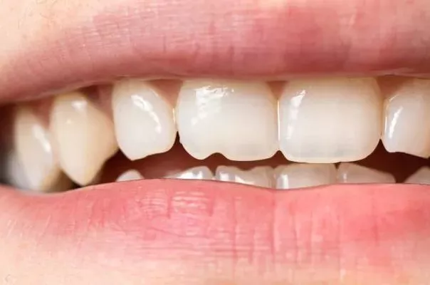 How to fix a cracked tooth naturally? 12 Fabulous Tips
