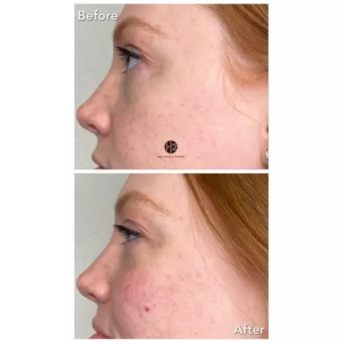 Let Me FILL You In On Cosmetic Fillers