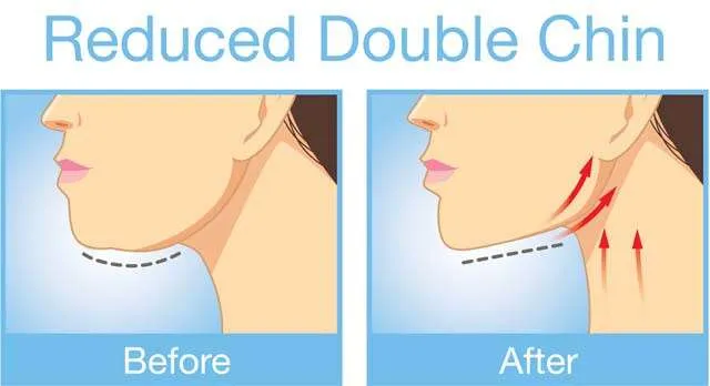 double chin exercises before after