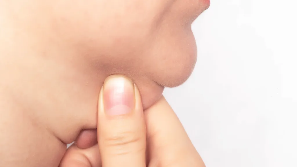 double chin removal