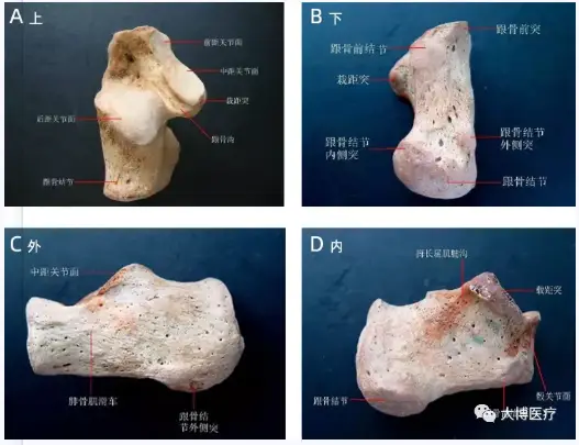跟骨骨折新型手术技术——双医疗跟骨钉系统 2 跟骨骨折是足部常见骨折之一,主要由外力创伤导致足跟部骨骼破坏,使其完整性或连续性中断。患者主要表现为剧烈疼痛、肿胀、瘀斑、足跟外翻畸形、扁平足、无法正常行走。.