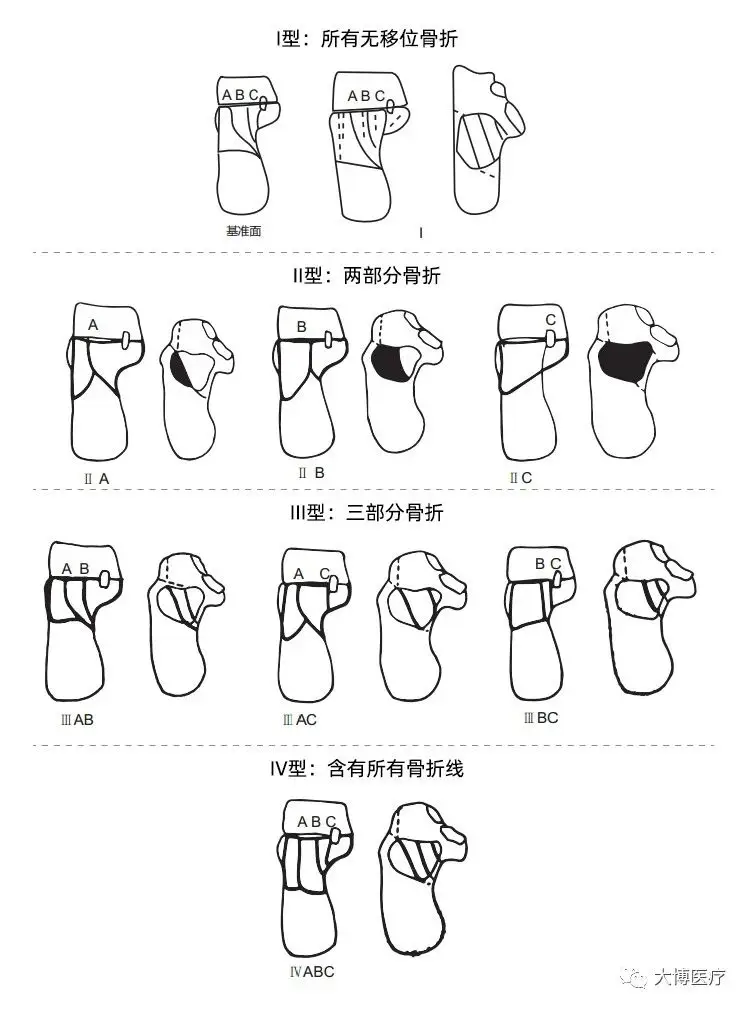 跟骨骨折新型手术技术——双医疗跟骨钉系统 3 跟骨骨折是足部常见骨折之一,主要由外力创伤导致足跟部骨骼破坏,使其完整性或连续性中断。患者主要表现为剧烈疼痛、肿胀、瘀斑、足跟外翻畸形、扁平足、无法正常行走。.