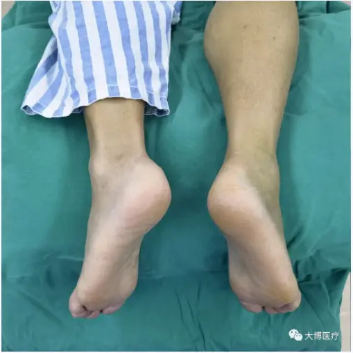 跟骨骨折新型手术技术——双医疗跟骨钉系统 5 跟骨骨折是足部常见骨折之一,主要由外力创伤导致足跟部骨骼破坏,使其完整性或连续性中断。患者主要表现为剧烈疼痛、肿胀、瘀斑、足跟外翻畸形、扁平足、无法正常行走。.