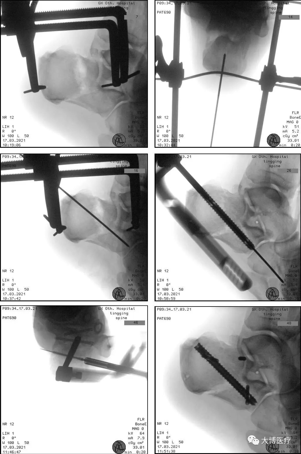 跟骨骨折新型手术技术——双医疗跟骨钉系统 6 跟骨骨折是足部常见骨折之一,主要由外力创伤导致足跟部骨骼破坏,使其完整性或连续性中断。患者主要表现为剧烈疼痛、肿胀、瘀斑、足跟外翻畸形、扁平足、无法正常行走。.