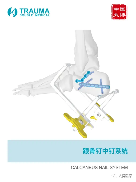 跟骨骨折新型手术技术——双医疗跟骨钉系统 9 跟骨骨折是足部常见骨折之一,主要由外力创伤导致足跟部骨骼破坏,使其完整性或连续性中断。患者主要表现为剧烈疼痛、肿胀、瘀斑、足跟外翻畸形、扁平足、无法正常行走。.