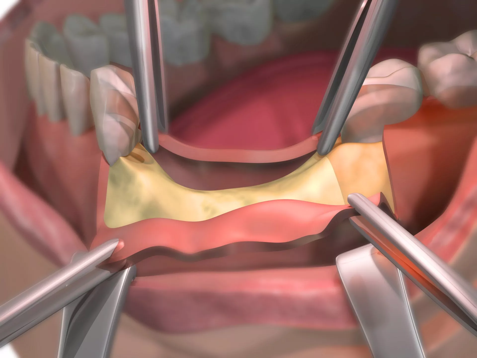 Sinus Lift Bone Grafting: Expanding Possibilities for Implants