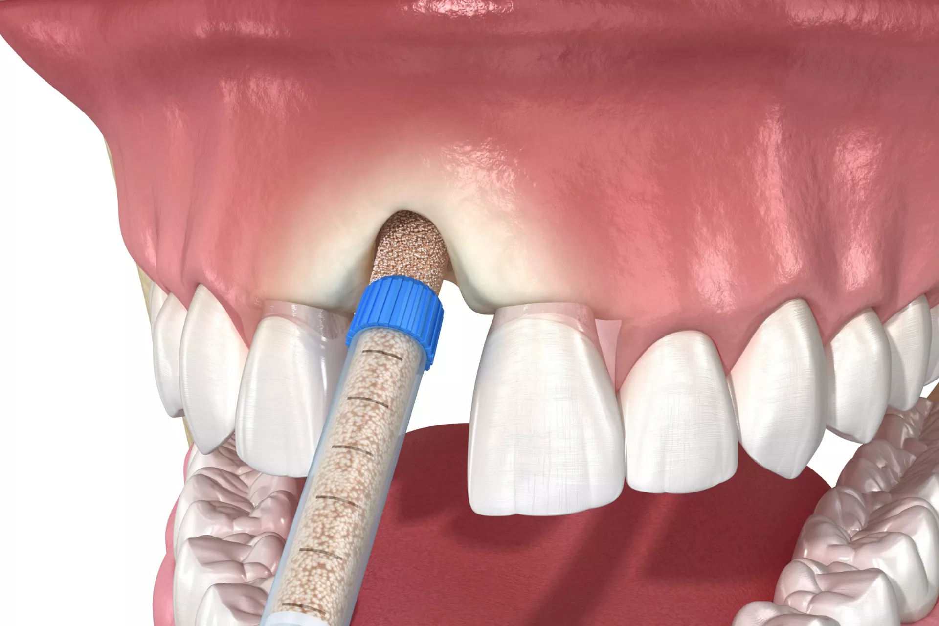 Bone Graft Surgery Preparation: How to Get Ready for the Procedure