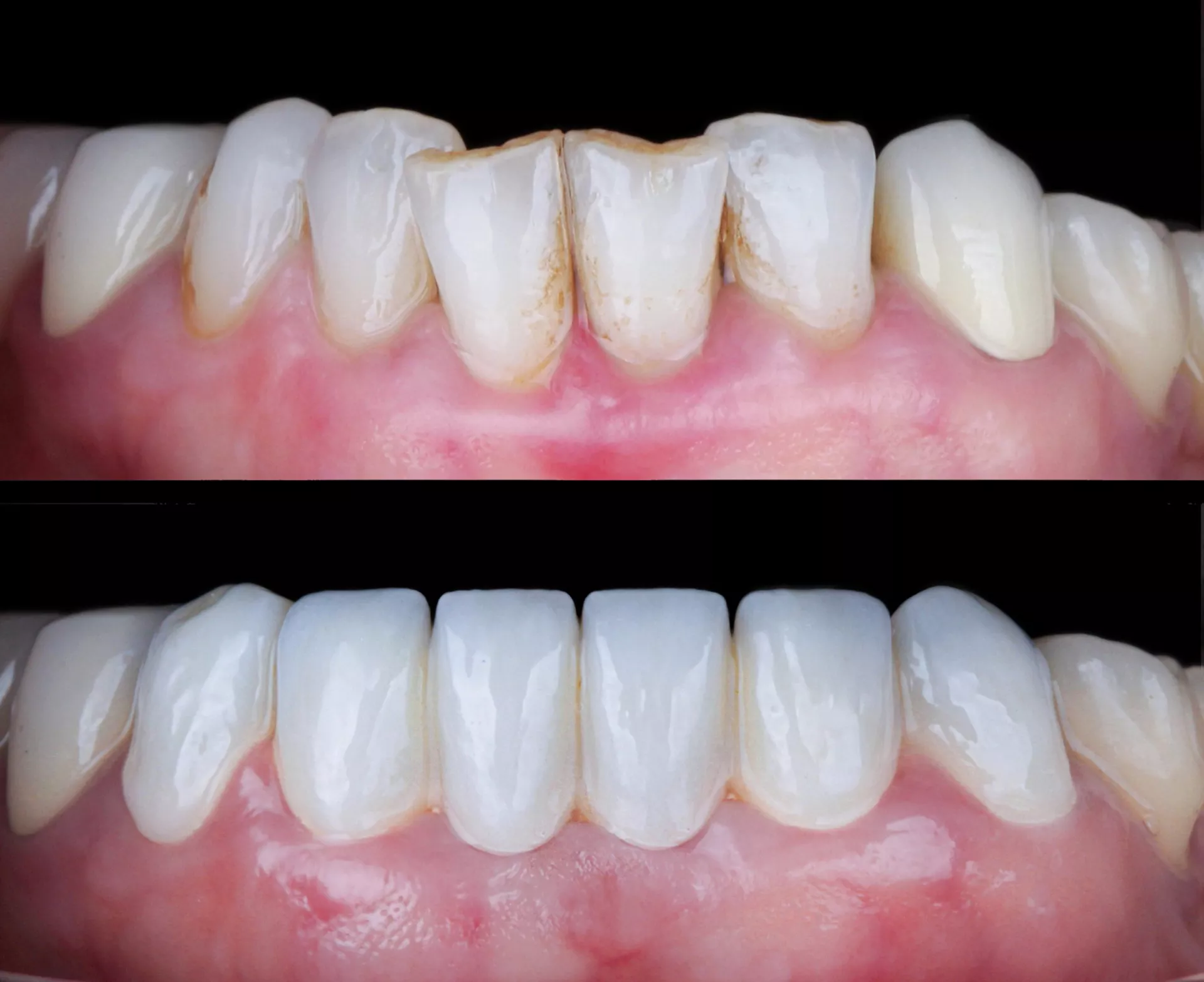 Bone Graft for Tooth Loss: Restoring Jaw Support Naturally