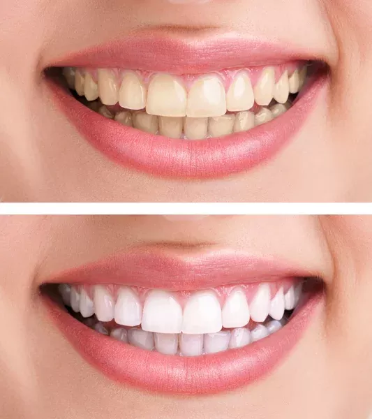 Teeth Whitening for Sensitive Teeth: How to Brighten Without the Burn