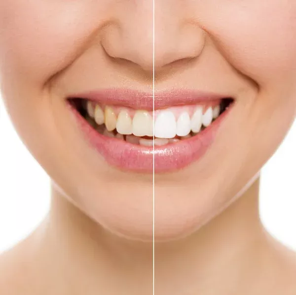Teeth Whitening for Smokers: Erase Stains and Restore Confidence