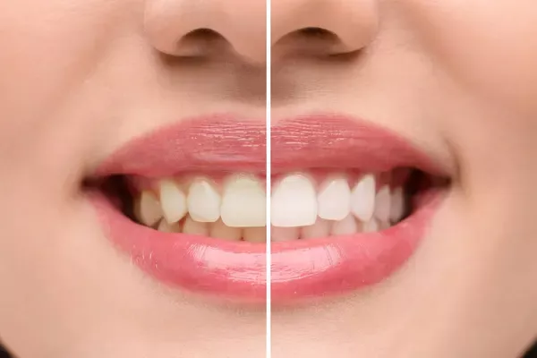 Teeth Whitening at Home Tips: Safe and Effective Ways to Boost Your Shine