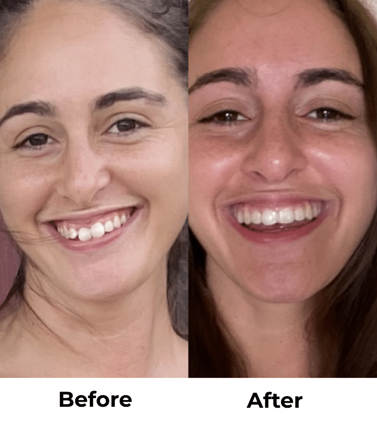 Candid Clear Aligners: The Affordable, Discreet Way to Straighten Your Teeth in Kirkland, WA 13 Kirkland Family Dentistry Before and After Clear Brace Aligners