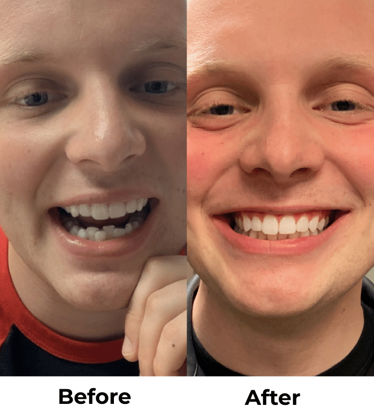 Candid Clear Aligners: The Affordable, Discreet Way to Straighten Your Teeth in Kirkland, WA 14 Kirkland Family Dentistry Before and After Clear Braces