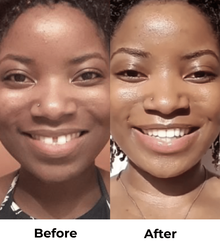 Candid Clear Aligners: The Affordable, Discreet Way to Straighten Your Teeth in Kirkland, WA 15 Kirkland Family Dentistry Before and After Clear Aligners