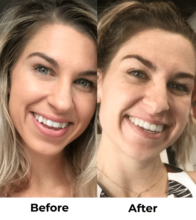 Candid Clear Aligners: The Affordable, Discreet Way to Straighten Your Teeth in Kirkland, WA 4 Kirkland Dentist Clear Braces Before and After