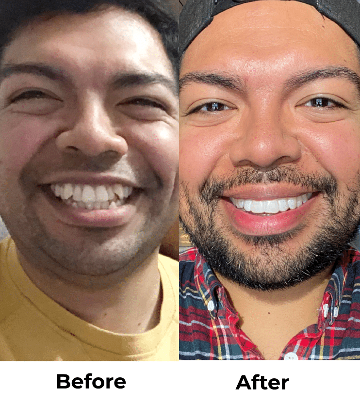 Candid Clear Aligners: The Affordable, Discreet Way to Straighten Your Teeth in Kirkland, WA 5 Kirkland Dentist Clear Aligners Before and After