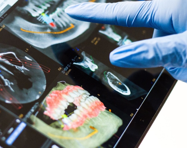 Candid Clear Aligners: The Affordable, Discreet Way to Straighten Your Teeth in Kirkland, WA 2 3D Scanning