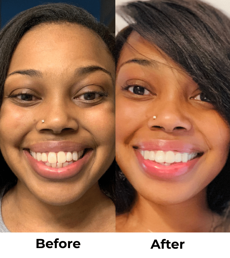 Candid Clear Aligners: The Affordable, Discreet Way to Straighten Your Teeth in Kirkland, WA 9 Kirkland Teeth Before and After With Clear Braces