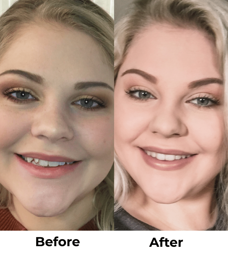 Candid Clear Aligners: The Affordable, Discreet Way to Straighten Your Teeth in Kirkland, WA 10 Clear Aligners Before and After Kirkland Family Dentistry