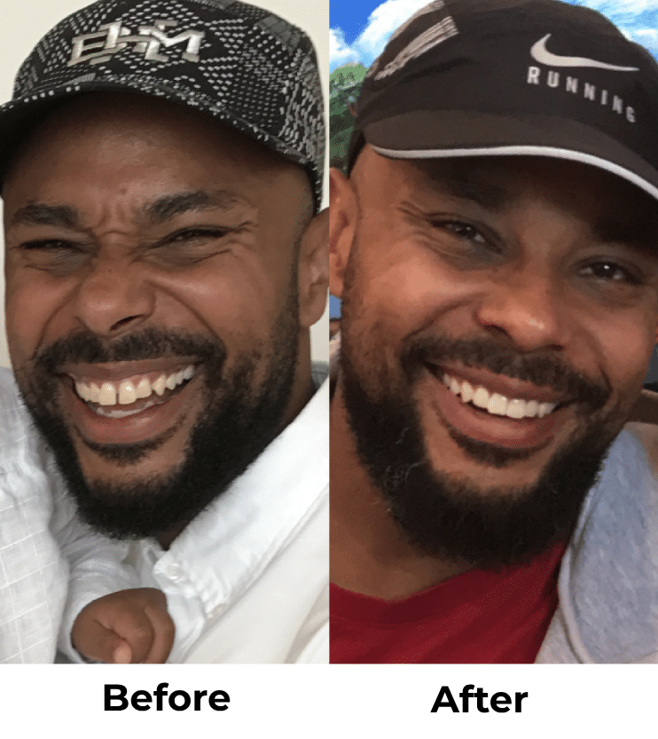 Candid Clear Aligners: The Affordable, Discreet Way to Straighten Your Teeth in Kirkland, WA 11 Clear Braces Before and After Kirkland Family Dentistry in Kirkland, WA