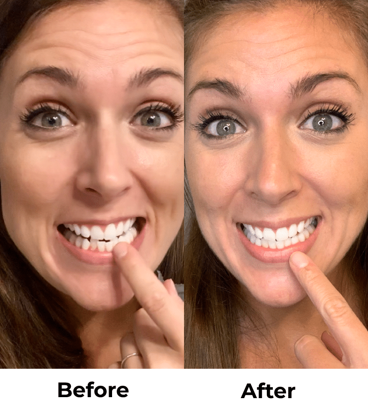 Candid Clear Aligners: The Affordable, Discreet Way to Straighten Your Teeth in Kirkland, WA 12 Clear Braces Before and After Kirkland Family Dentistry