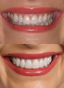 How to Take Care of Dental Veneers 1 How to Take Care of Dental Veneers