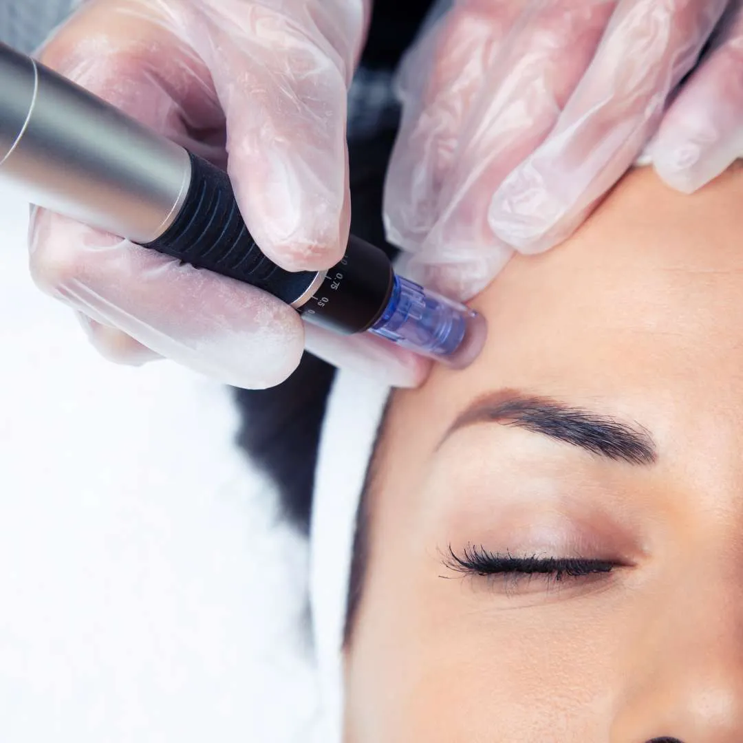 Youth Renewal with Exosomes at Las Vegas Skin Pros Microneedling - Las Vegas Skin Pros | Med Spa Youth Renewal with Exosomes at Las Vegas Skin Pros Microneedling