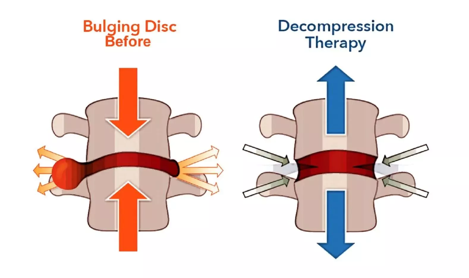 Spinal Decompression Therapy - Aloha Family Chiropractic