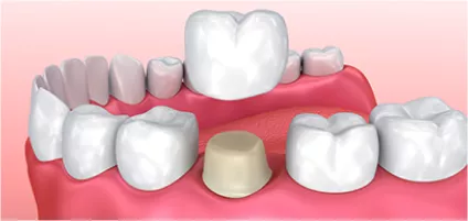 Dental Crown and Cap Image