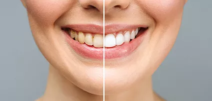 woman teeth before and after whitening. Over white background. Dental clinic patient. Image symbolizes oral care dentistry, stomatology