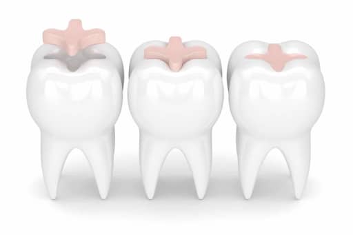 Understanding the Difference Between Inlays and Onlays 3 A 3D render of teeth with dental inlay precision