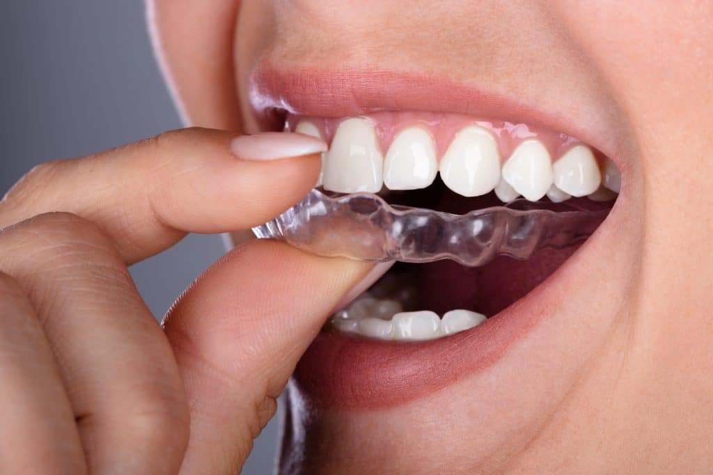 Straighten Your Smile Discreetly with Clear Aligners 1 Close-up of a woman’s hand putting transparent aligner in teeth