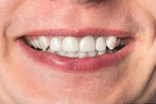 How Dental Crowns Protect and Strengthen Damaged Teeth 2 Incisive tooth restoration photo before and after