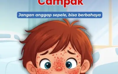 Waspada Bahaya Campak