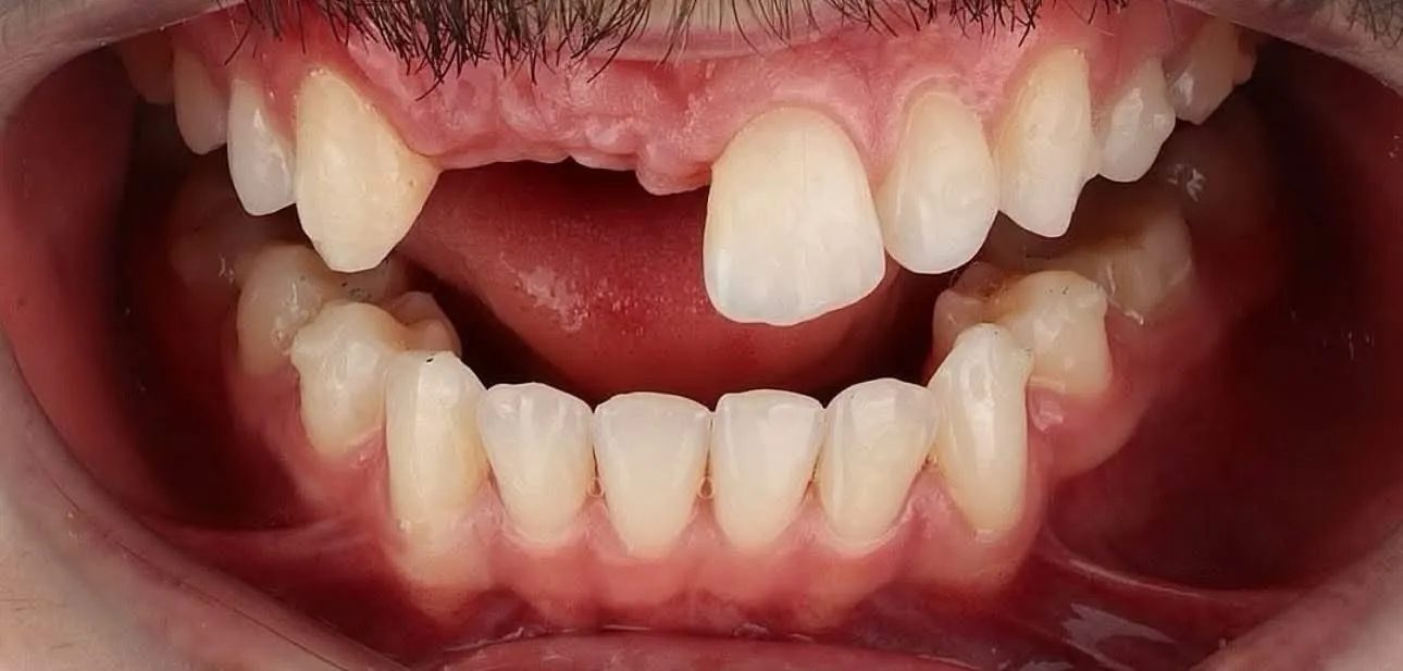 before-broken-teeh before-broken-teeh