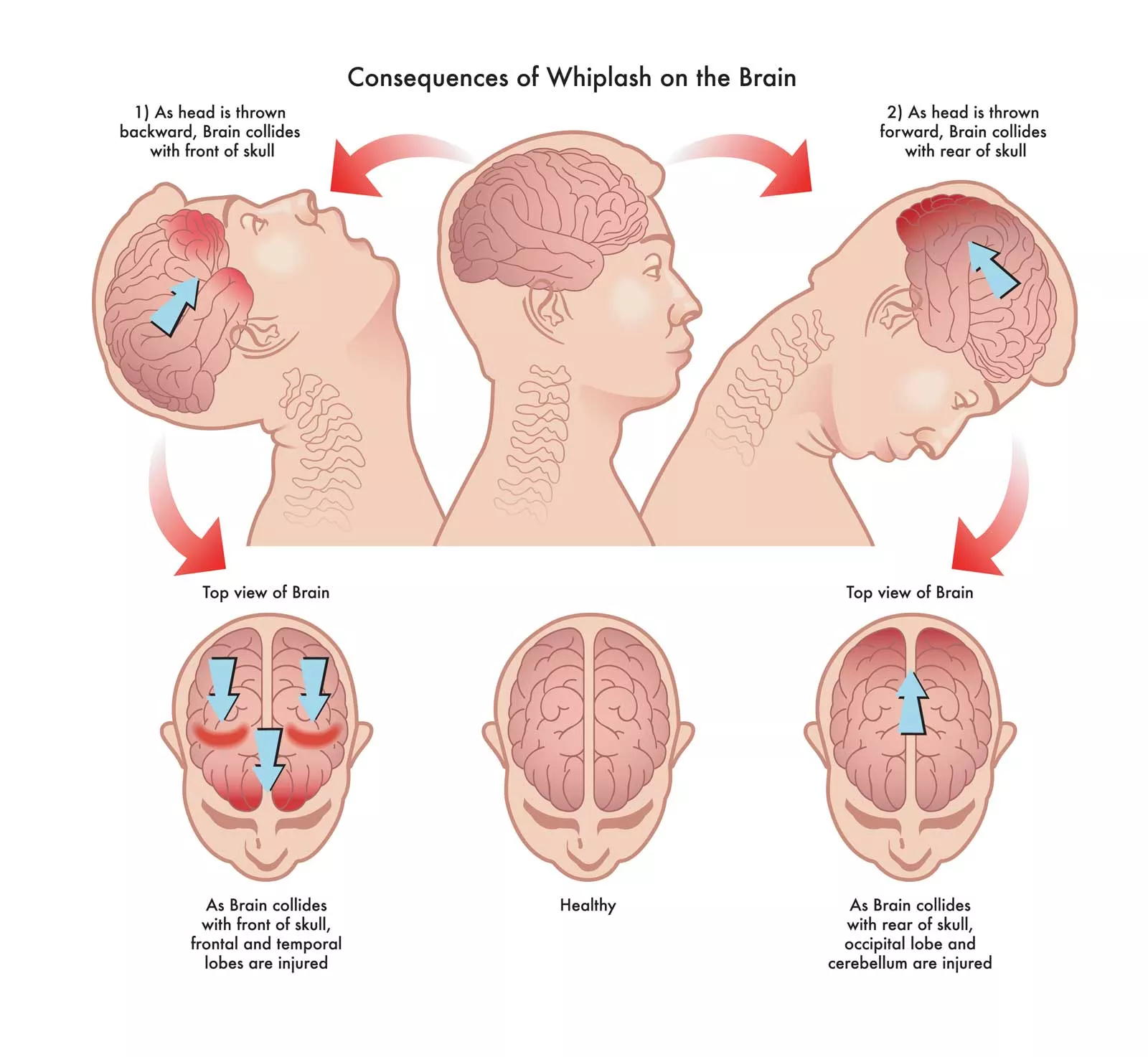 Body's response to whiplash