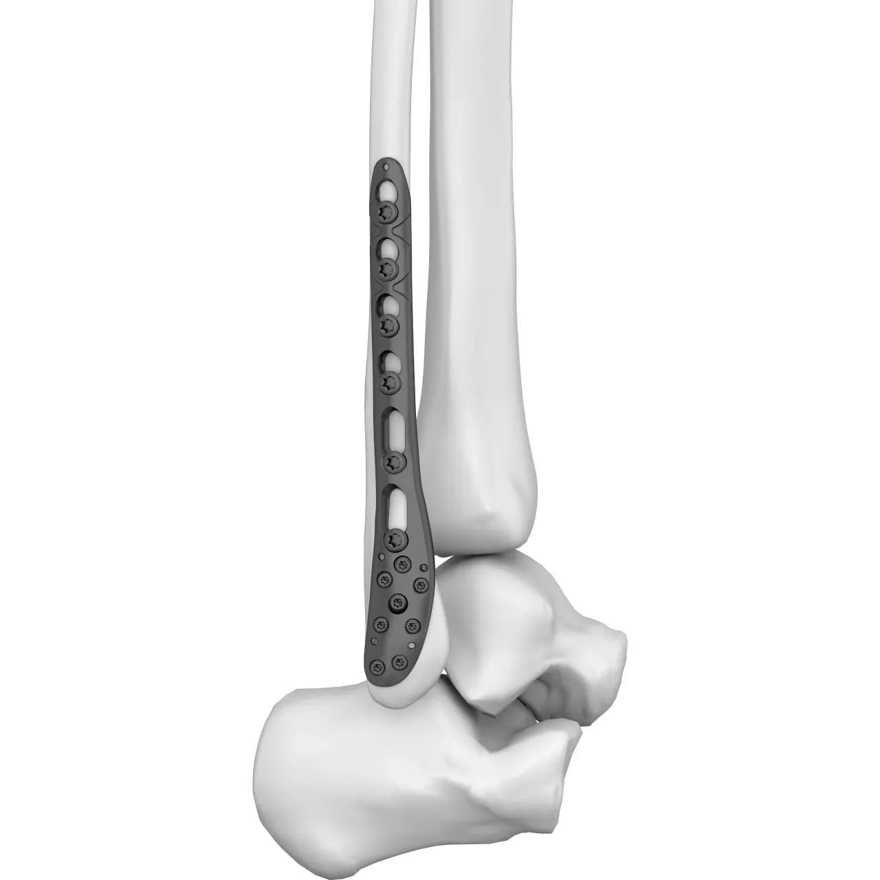 Distal Lateral Fibular Locking Plate | Boneunion Medical, image size:1280x1280