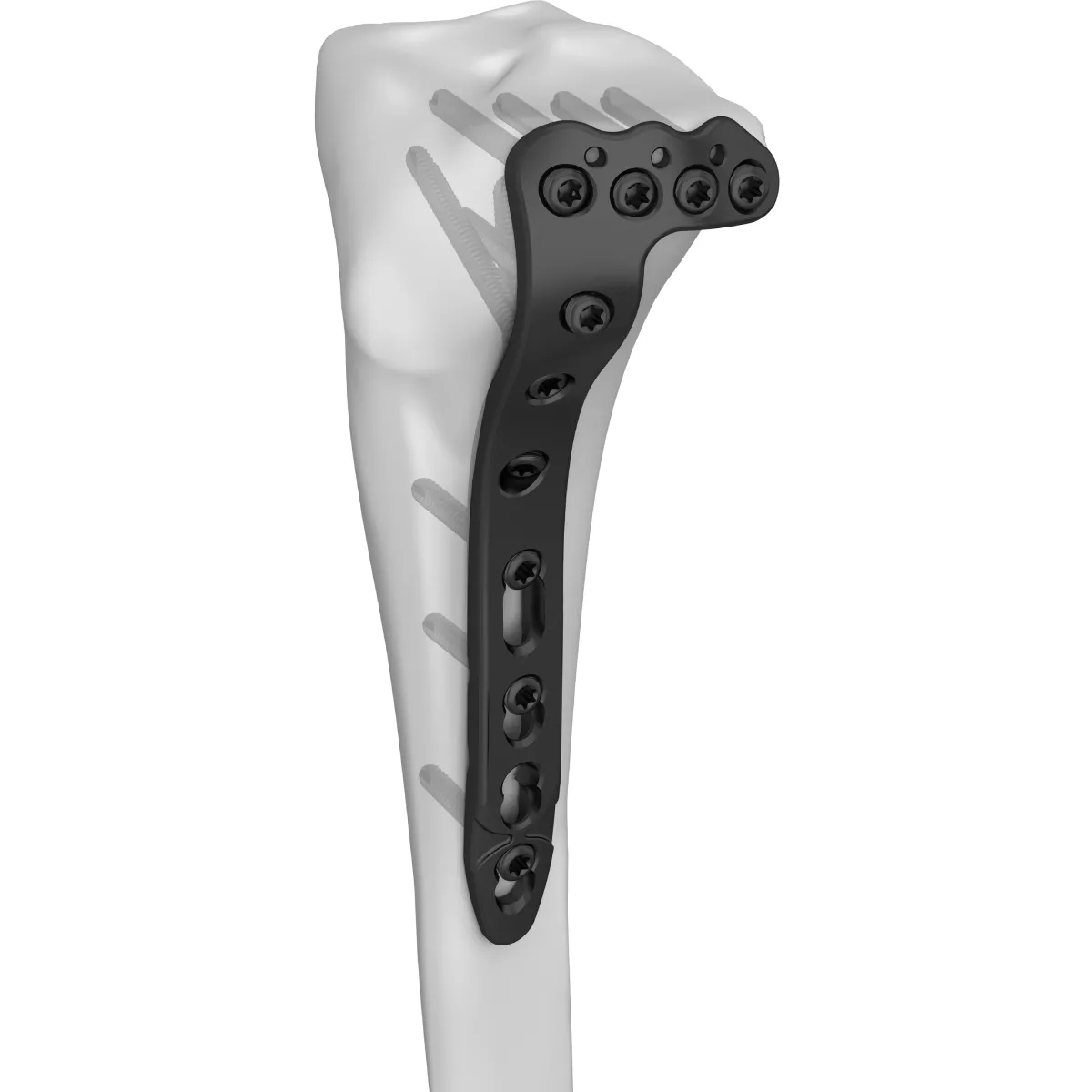 Proximal Lateral Tibial SR Locking Plate | Boneunion Medical, image size:1200x1200