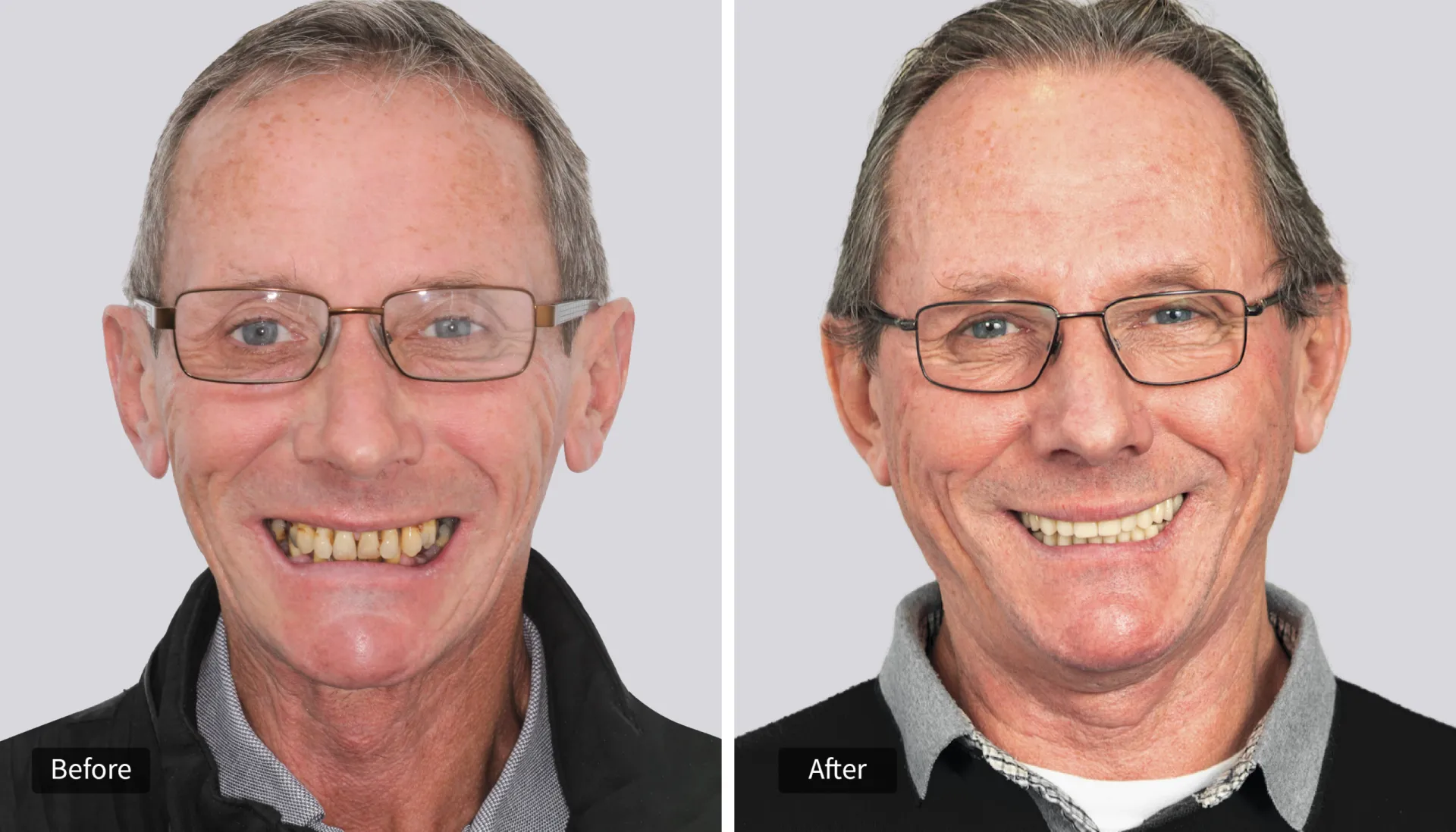 invisalign clear braces