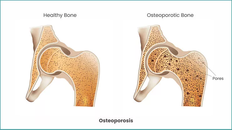 Osteoporosis | Carolina Regional Orthopaedics