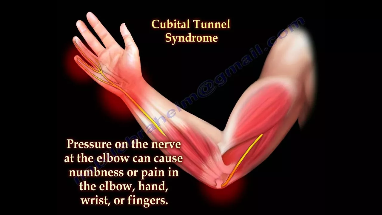 Cubital Tunnel Syndrome Ulnar Nerve Entrapment - Everything You Need To Know - Dr. Nabil Ebraheim