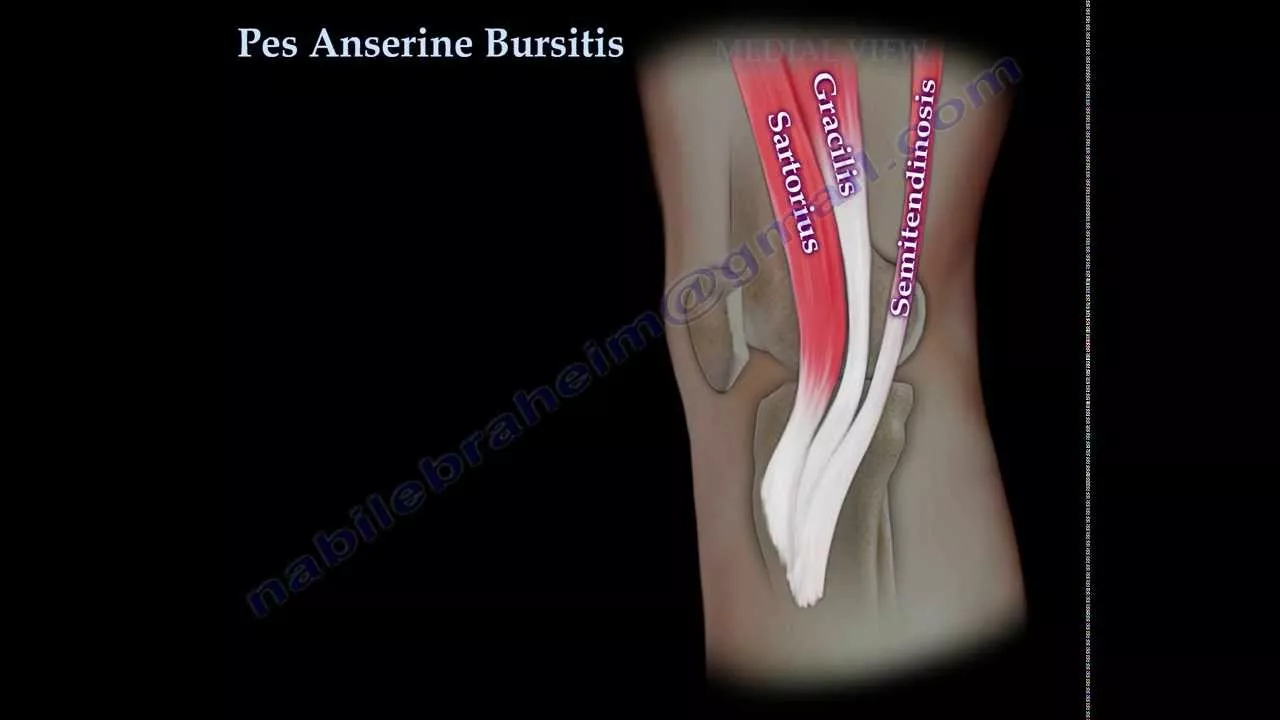 Pes Anserine Bursitis , knee pain - Everything You Need To Know - Dr. Nabil Ebraheim